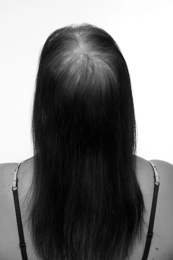 tritec-hair-vorher-w-600×900